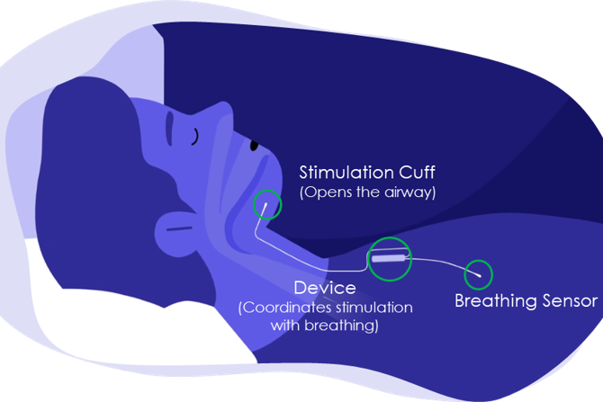 Inspire Therapy Diagram